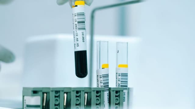 NHS Introduces ‘Revolutionary’ Blood Test for Cancer Detection