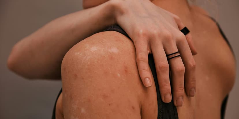Surging Measles Cases in the U.S. Threaten Two Decades of Disease Elimination Progress
