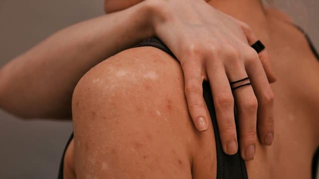 Surging Measles Cases in the U.S. Threaten Two Decades of Disease Elimination Progress